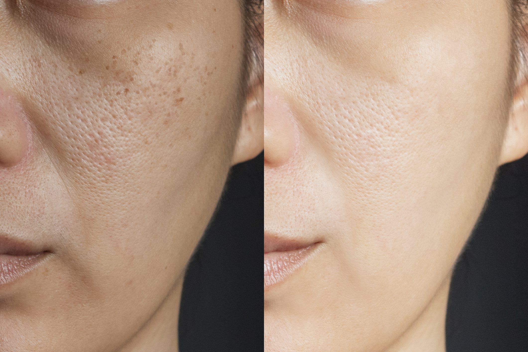 two pictures compare effect Before and After treatment. skin with problems of freckles , pore , dull skin and wrinkles before and after treatment to solve skin problem for better skin result two pictures compare effect Before and After treatment. skin with problems of freckles , pore , dull skin and wrinkles before and after treatment to solve skin problem for better skin result