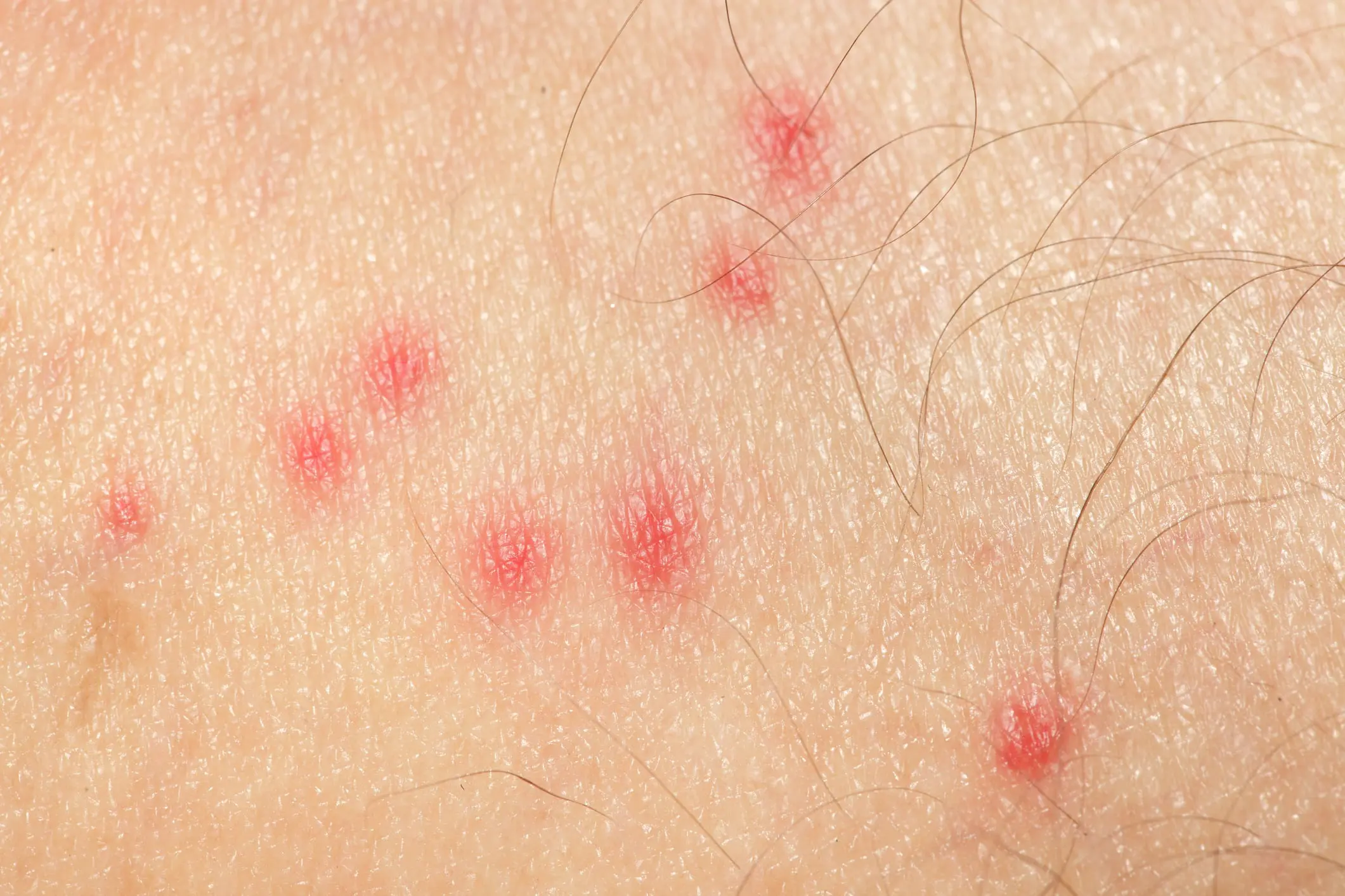 Bug Bites, Midwest Express Clinic