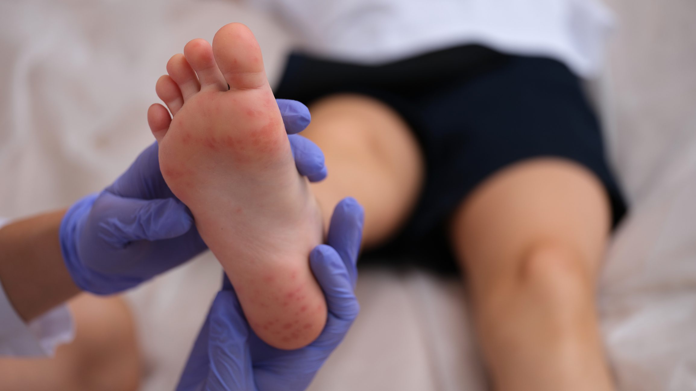 Infectious disease provider examining rash on skin of child feet closeup Infectious disease provider examining rash on skin of child feet closeup.