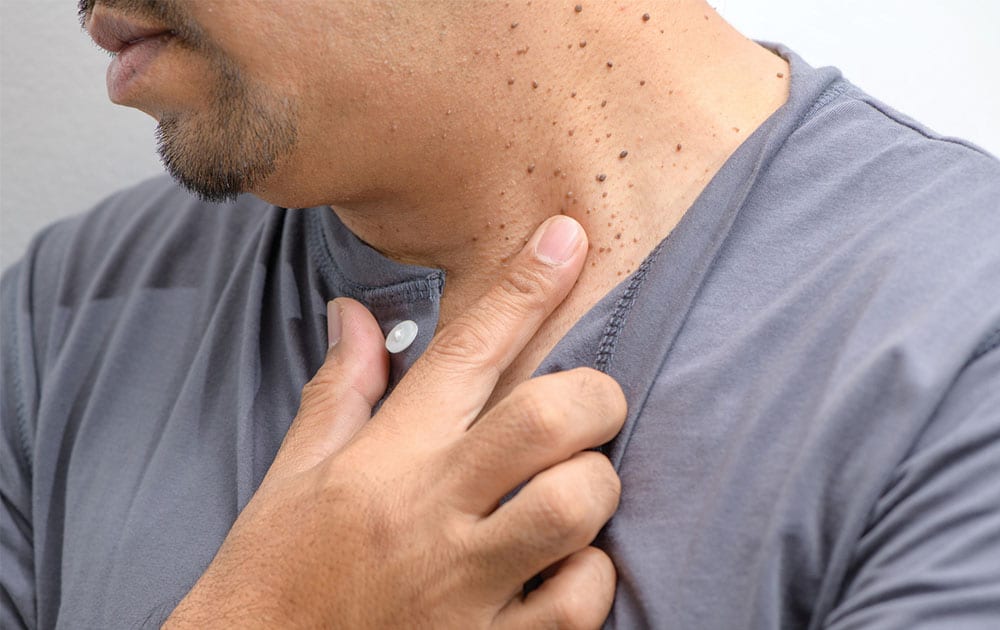 skin-tag-removal skin-tag-removal
