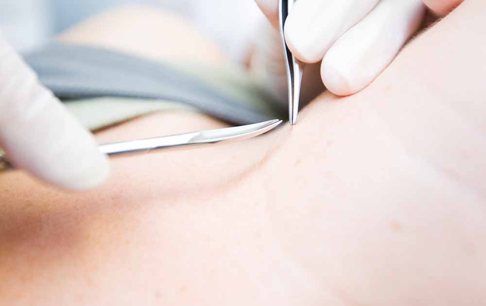 skin tag