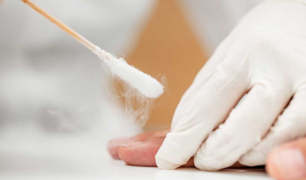 wart-removal wart-removal