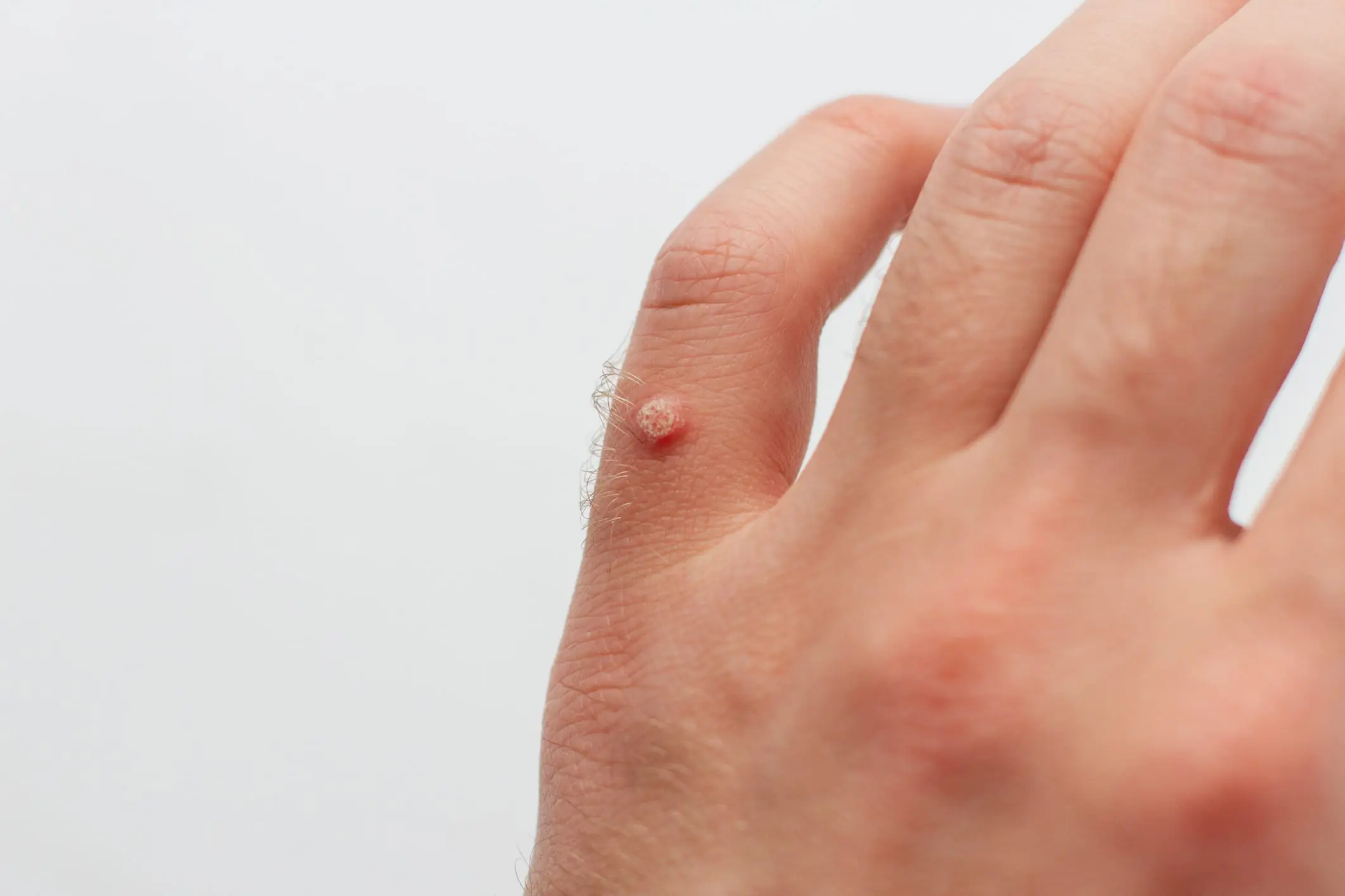 Plantar Warts & Wart Removal Midwest Express Clinic